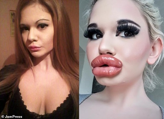 Lady with world biggest lips shows off her pout after 20th lip injection