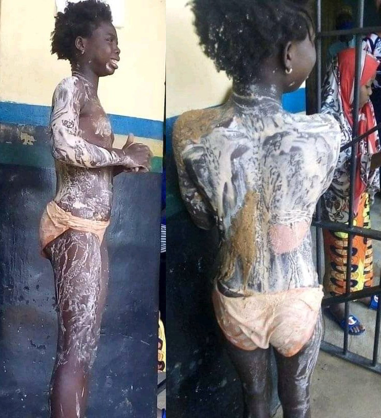Heart-breaking photos of girl whose aunt poured hot water on her body