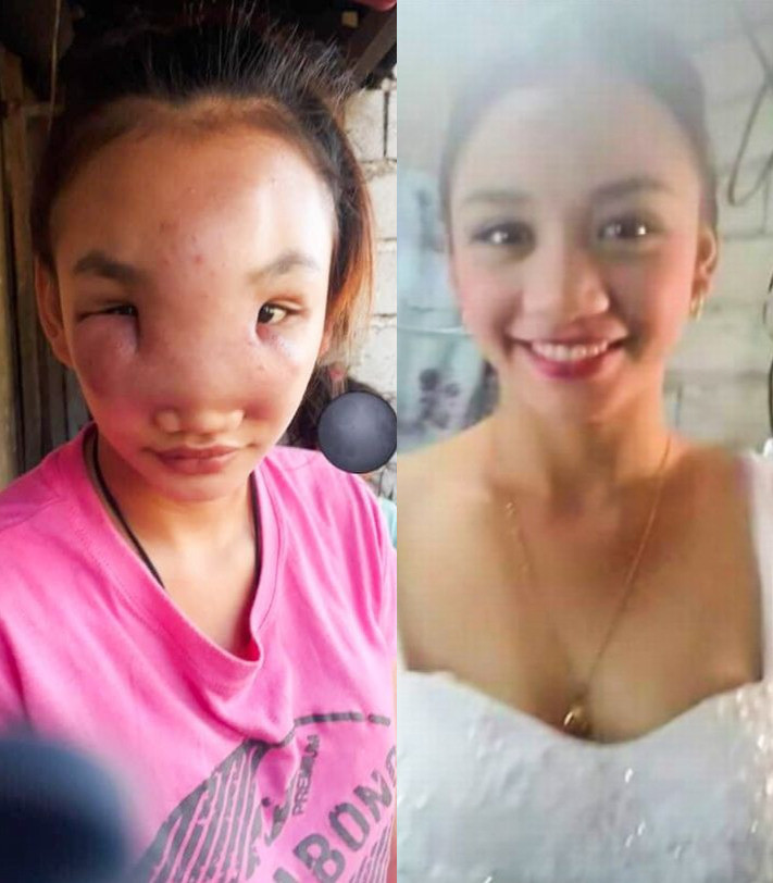 Philippines: Teenager turning blind after squeezing a spot on her nose-TopNaija.ng