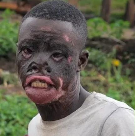 Man pleads with his wife to return after she left due to his burnt face