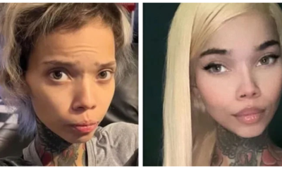 Instagram Model Who Is HIV Positive Goes Blind Again After Eye Surgery