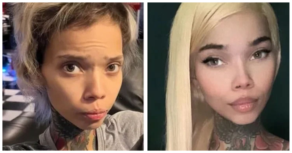 Instagram Model Who Is HIV Positive Goes Blind Again After Eye Surgery