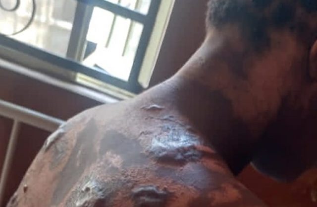 Landlady Allegedly Attacks Tenant With Hot Water In Anambra (Photo)