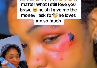 Lady shares bruises she got after asking her man for N150K (VIDEO)