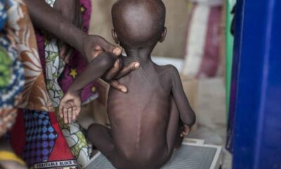 Hardship: Federal Govt confirms over 4million kids malnourished in Nigeria